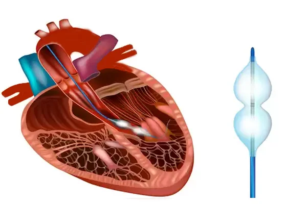 Balloon Valvuloplasty